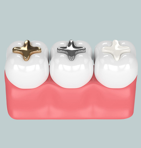 Three dental crowns with different metal bases displayed on pink model gum base.