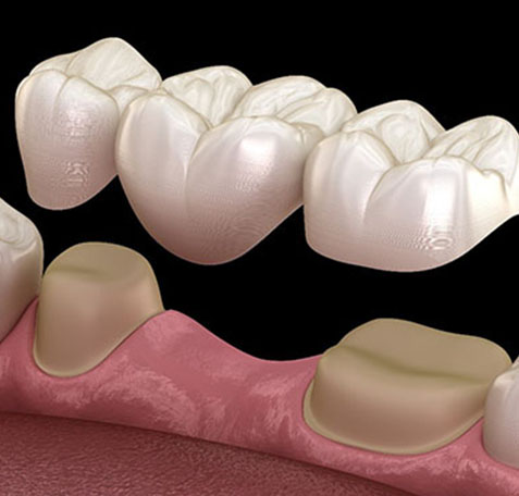 Dental bridge restoration showing replacement teeth suspended over gum tissue in cross-section view.