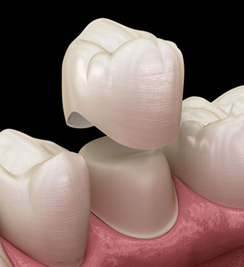 Dental crowns on model teeth showing cosmetic restoration and gum tissue placement.