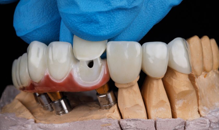 Featured image for “Unveiling the Vital Role of Dental Crowns in Restoring Smiles”