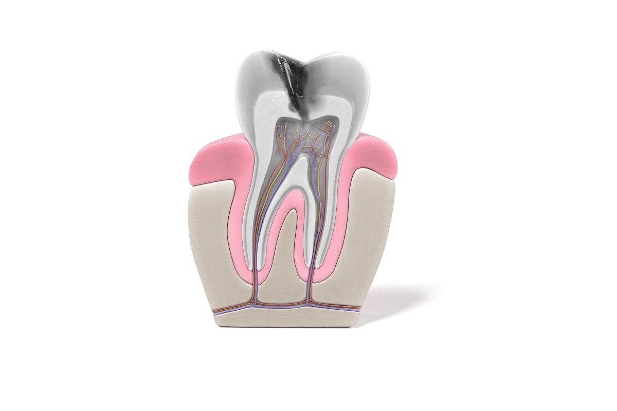 Featured image for “How to Overcome Dental Anxiety Before Root Canal Treatment”