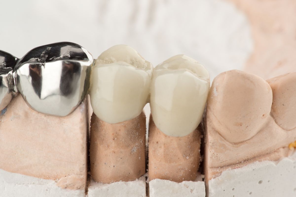 Featured image for “The Impact of Dental Bridges on Oral Health”