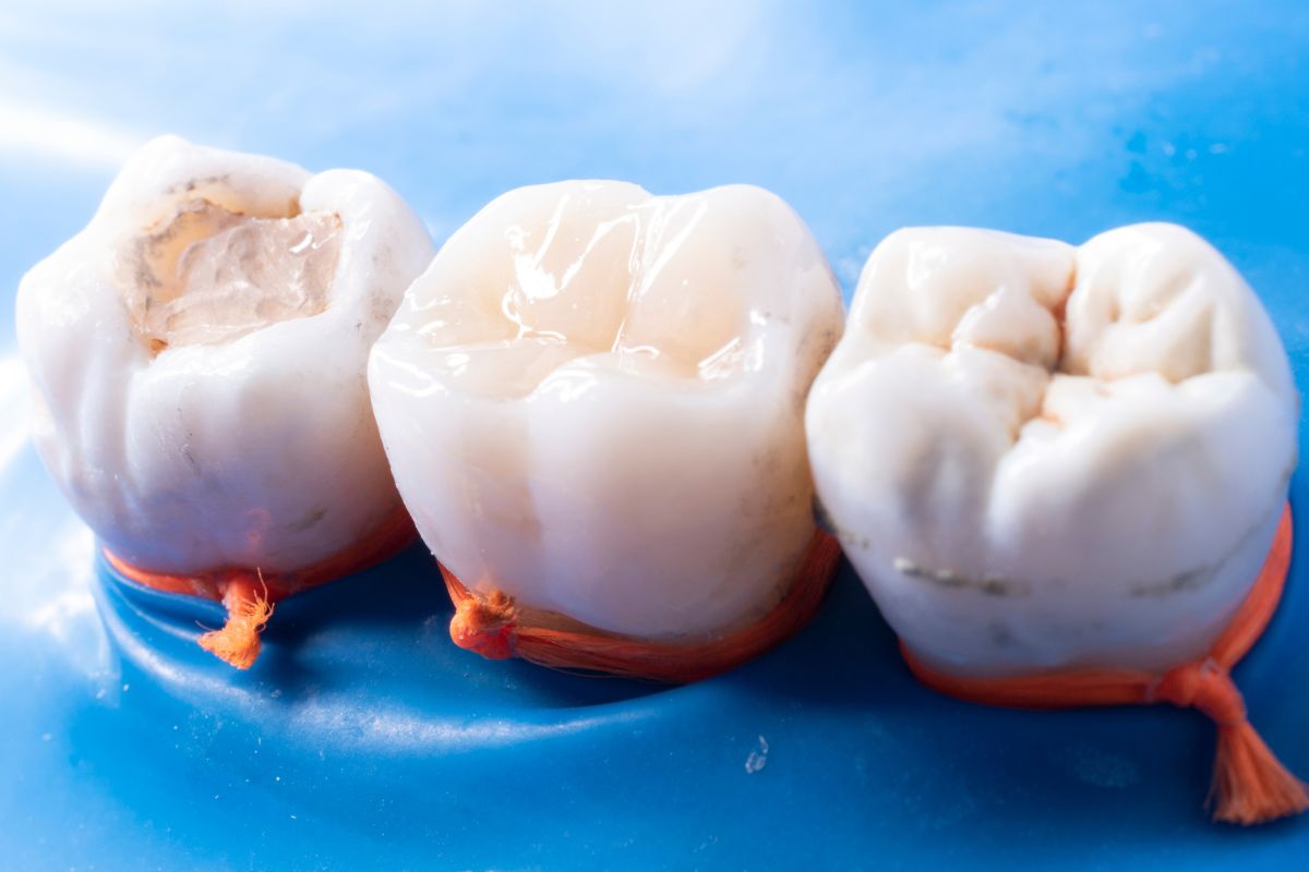 Featured image for “Comparing Traditional and Composite Fillings: Which is Right for You?”