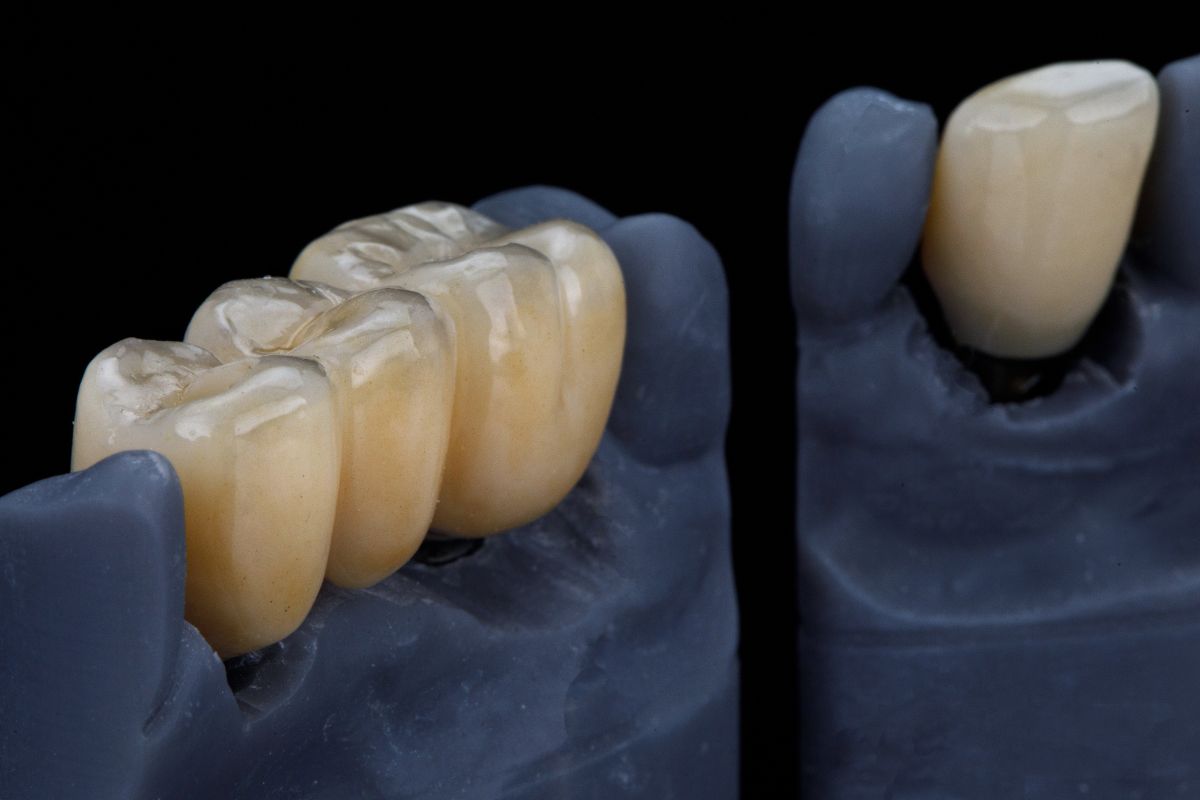 Featured image for “What to Do If Your Dental Crown Breaks: Immediate Steps and Solutions”